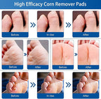 24 Count Corn Removal Pads for Feet and Toe, Corn Feet Remover for Feet Extra - Image 5